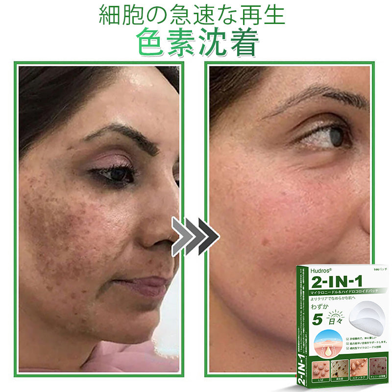 𝐇𝐮𝐝𝐫𝐨𝐬® 📌 𝟐-𝐢𝐧-𝟏 ハイドロコロイドマイクロニードルパッチ｜盛り上がったほくろ、ニキビ、平らなイボおよび皮膚の突起の除去用に特別設計｜𝟏𝟒𝟒枚入りパッケージ🌱🌱