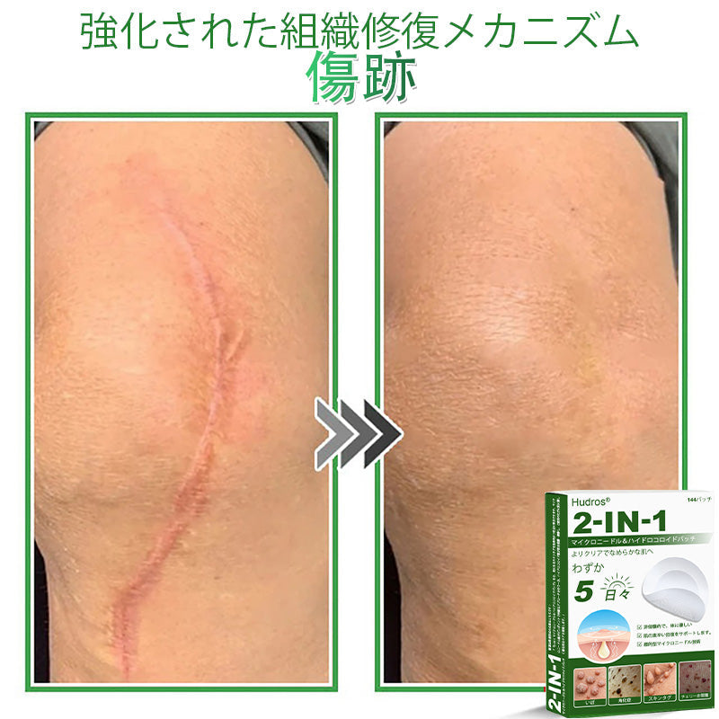 𝐇𝐮𝐝𝐫𝐨𝐬® 📌 𝟐-𝐢𝐧-𝟏 ハイドロコロイドマイクロニードルパッチ｜盛り上がったほくろ、ニキビ、平らなイボおよび皮膚の突起の除去用に特別設計｜𝟏𝟒𝟒枚入りパッケージ🌱🌱