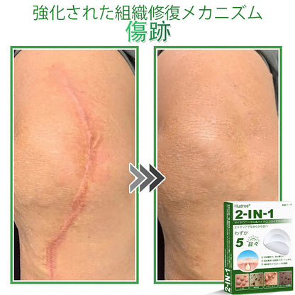 𝐇𝐮𝐝𝐫𝐨𝐬® 📌 𝟐-𝐢𝐧-𝟏 ハイドロコロイドマイクロニードルパッチ｜盛り上がったほくろ、ニキビ、平らなイボおよび皮膚の突起の除去用に特別設計｜𝟏𝟒𝟒枚入りパッケージ🌱🌱