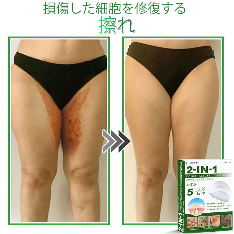 𝐇𝐮𝐝𝐫𝐨𝐬® 📌 𝟐-𝐢𝐧-𝟏 ハイドロコロイドマイクロニードルパッチ｜盛り上がったほくろ、ニキビ、平らなイボおよび皮膚の突起の除去用に特別設計｜𝟏𝟒𝟒枚入りパッケージ🌱🌱